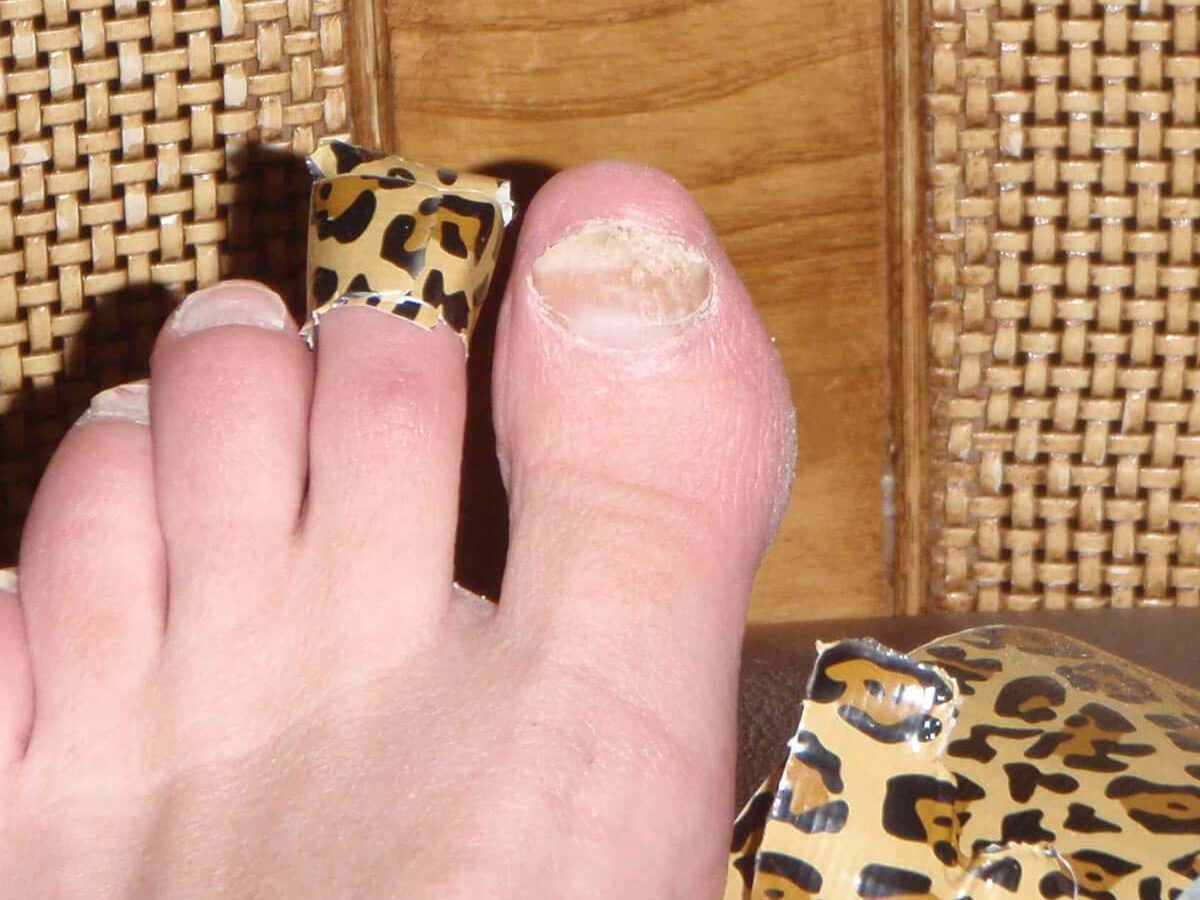 Fungus Toe Nail Remedy