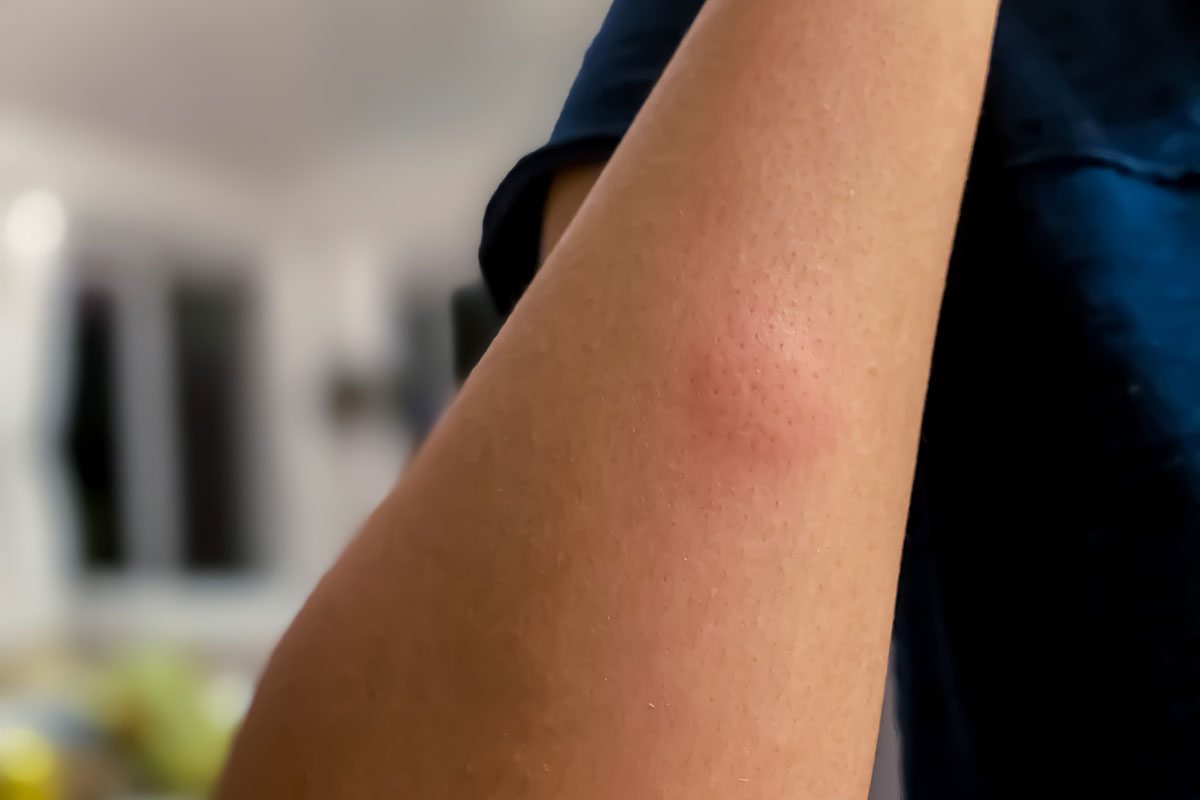 How to Get Rid of Mosquito Bites ASAP