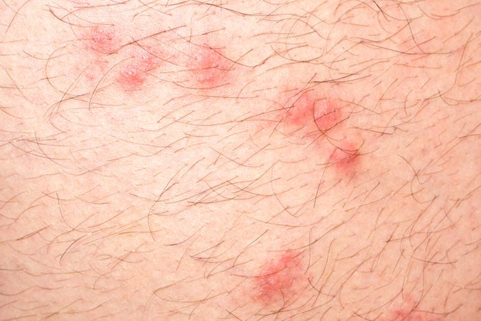 close up of flea bites on human skin