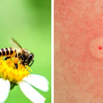 A bee gathers nectar from a yellow flower's center, while a close-up shows a red bump on skin, indicating a possible sting reaction.
